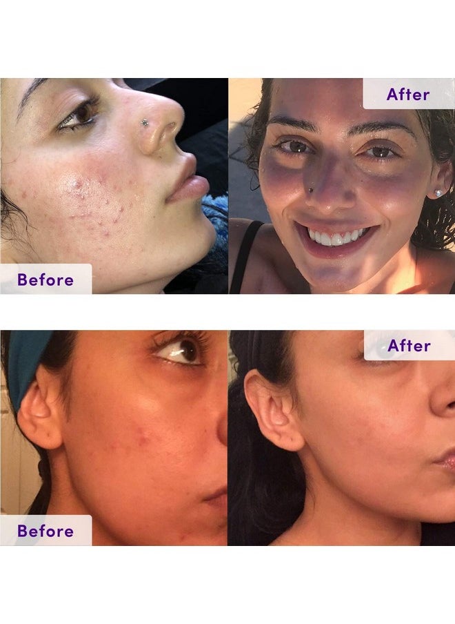 NXN - NxN Acne Treatment Kit 4-Step Clear Skin System with Salicylic Acid, Probiotics, Sulfer & Natural Retinols, Control Blemishes & Breakouts, Face Care Solution Set for All Skin Types Including Sensitive - Image 1