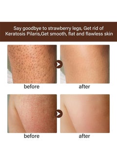 MOOYAM Women's Strawberry Legs Treatment, Rough Bump Body Cream, Dry Skin Lotion, Strawberry Skin Remover, Pilaris Keratosis Pilaris Treatment Moisturising Cream Body Moisturiser For Brightening Dry Areas  - Image 4