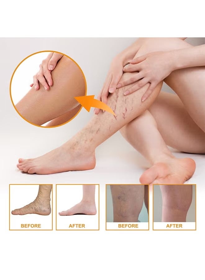 EELHOE Vitamin K Varicose Veins Cream, Soothing Leg Cream, Varicose and Spider Veins Treatment Cream, Improve Blood Circulation, Fast Relieve Swelling Pain 60g - Image 3