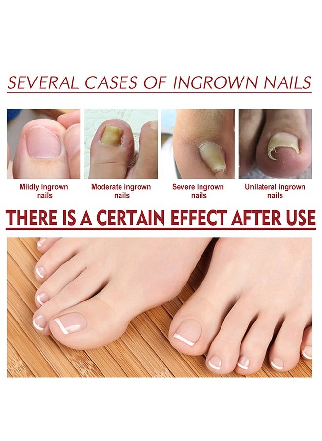 Lanthome Anti Paronychia Relief Oil,Toenailcare Removal Paronychia Oil, Bunion Therapy Oil, Toenailcare Anti Paronychia Relief Oil Repair For Damaged Discolored Thick Nails 10ML  - Image 5