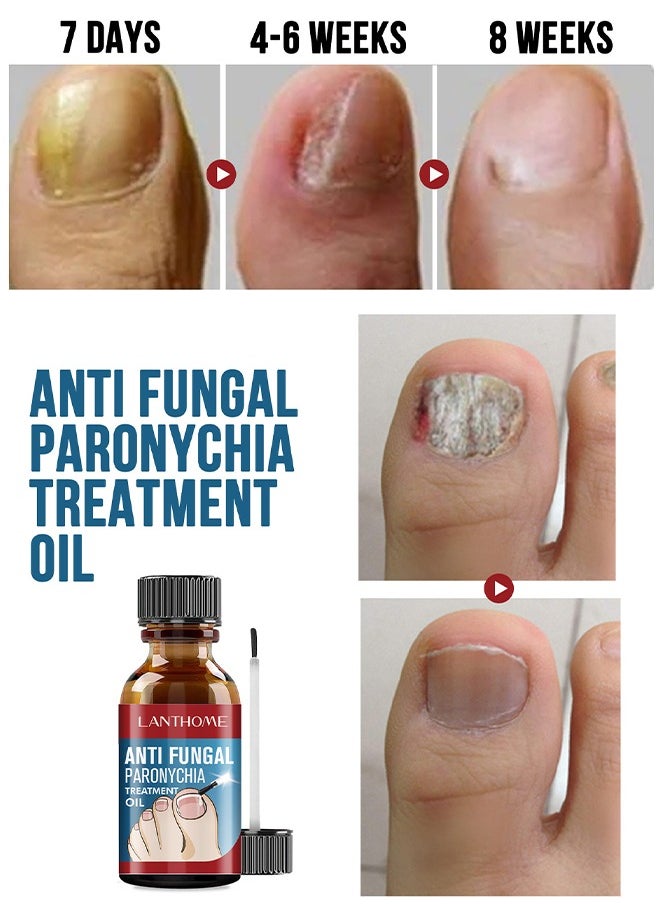 Lanthome Anti Paronychia Relief Oil,Toenailcare Removal Paronychia Oil, Bunion Therapy Oil, Toenailcare Anti Paronychia Relief Oil Repair For Damaged Discolored Thick Nails 10ML  - Image 4