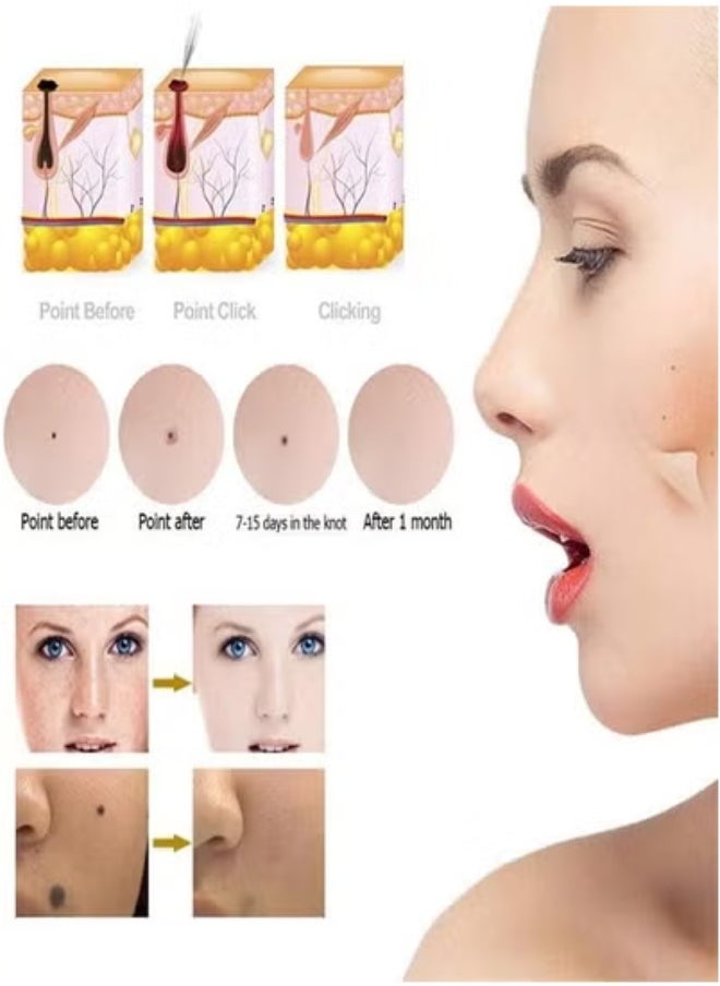 General Home Use Pico Laser Pen for Mole and Freckle Removal, Painless Beauty Device for Spot and Tattoo Removal, Convenient Mole and Freckle Removal Pen  - Image 3