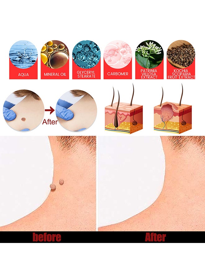 ساوث مون مرهم الثؤلول مع حمض الساليسيليك ، تجميد مزيل الثآليل ، مرهم مزيل الثآليل ، تجميد الثآليل سريع المفعول ، مزيل الثآليل للثآليل التناسلية ، الثآليل الأخمصية ، الثآليل الشائعة ، الذرة ، كريم الثآليل 20 جم - Image 2