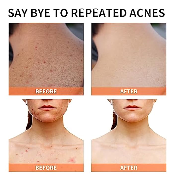YAFUSIPE Acne Treatment for Face for Hormonal Cystic Stubborn Acne Cream for Sensitive Skin Teens Adults Women Men Spot Pimple Butt Control Rapid Clearing Breakout Overnight Face Blemish Treatment - Image 5