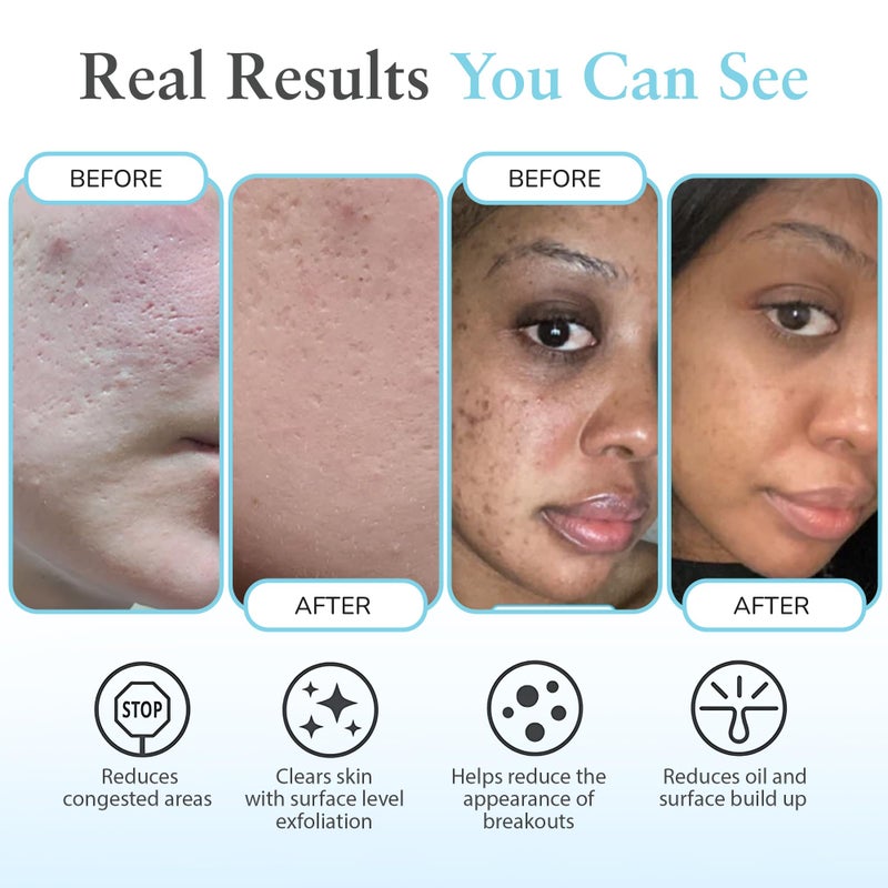 PERFECT IMAGE Salicylic 10% Gel Peel, Breakout and Pore Minimizer and Cleanser, 15-30 Full Facial Chemical Peels, 1 fl oz. e, 30 mL â€“ Perfect Image - Image 4