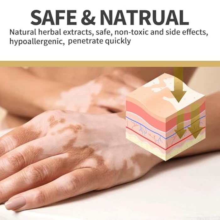 RCSCBC Vitiligo Treatment,Vitiligo Care Cream，Effective Improves for Skin Pigmentation - Image 5