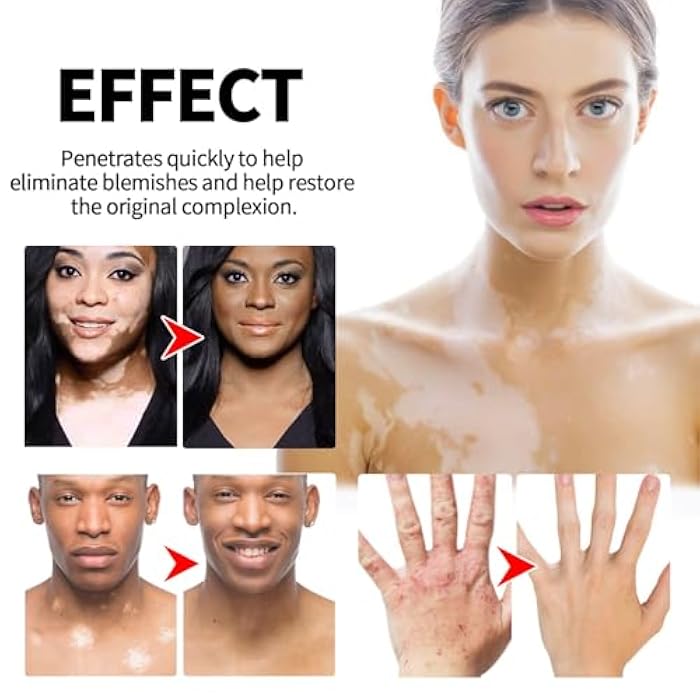 RCSCBC Vitiligo Treatment,Vitiligo Care Cream，Effective Improves for Skin Pigmentation - Image 4