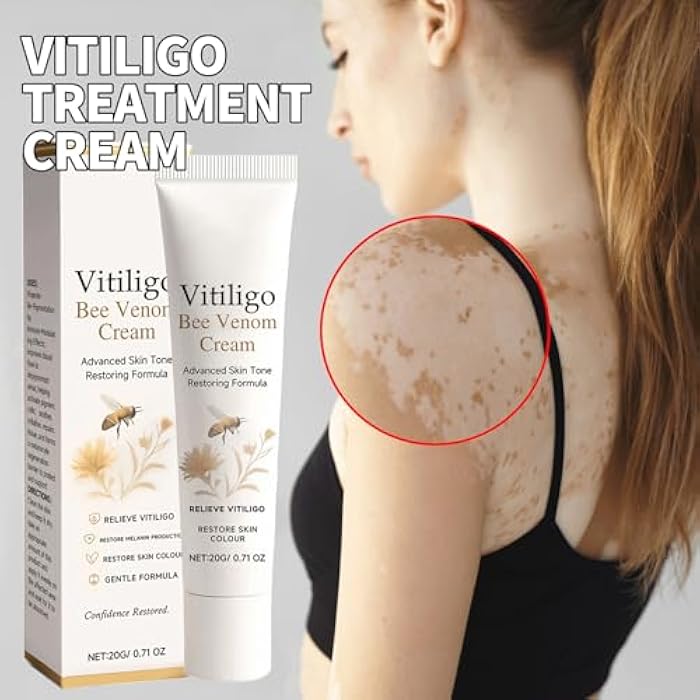 RCSCBC Vitiligo Treatment,Vitiligo Care Cream，Effective Improves for Skin Pigmentation - Image 2