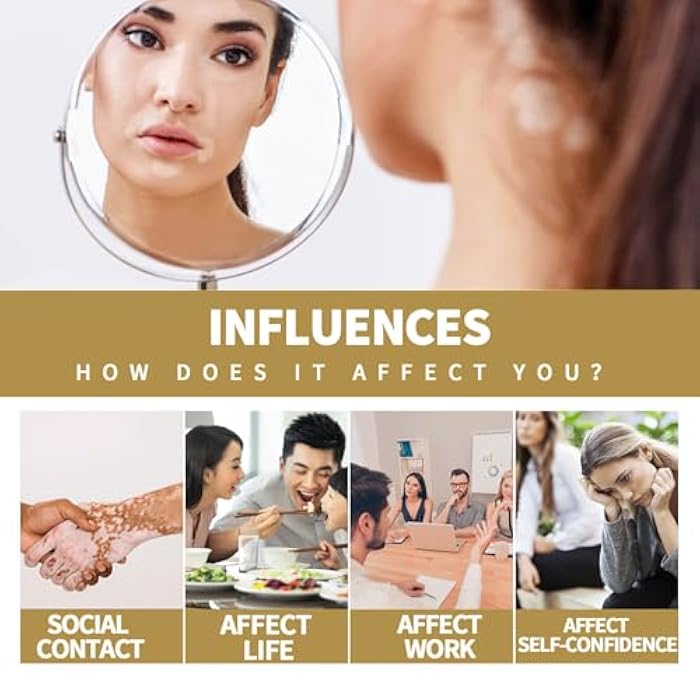 RCSCBC Vitiligo Treatment,Vitiligo Care Cream，Effective Improves for Skin Pigmentation - Image 3