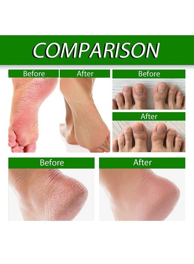 EELHOE Allantoin 40% Cream- Foot Care Cream  For Cracked,Rough Thick and Dry Skin Soothes and Softens Feet,Elbows and Knees Hydrating and Moisturizing Foot Care Cream - Image 5