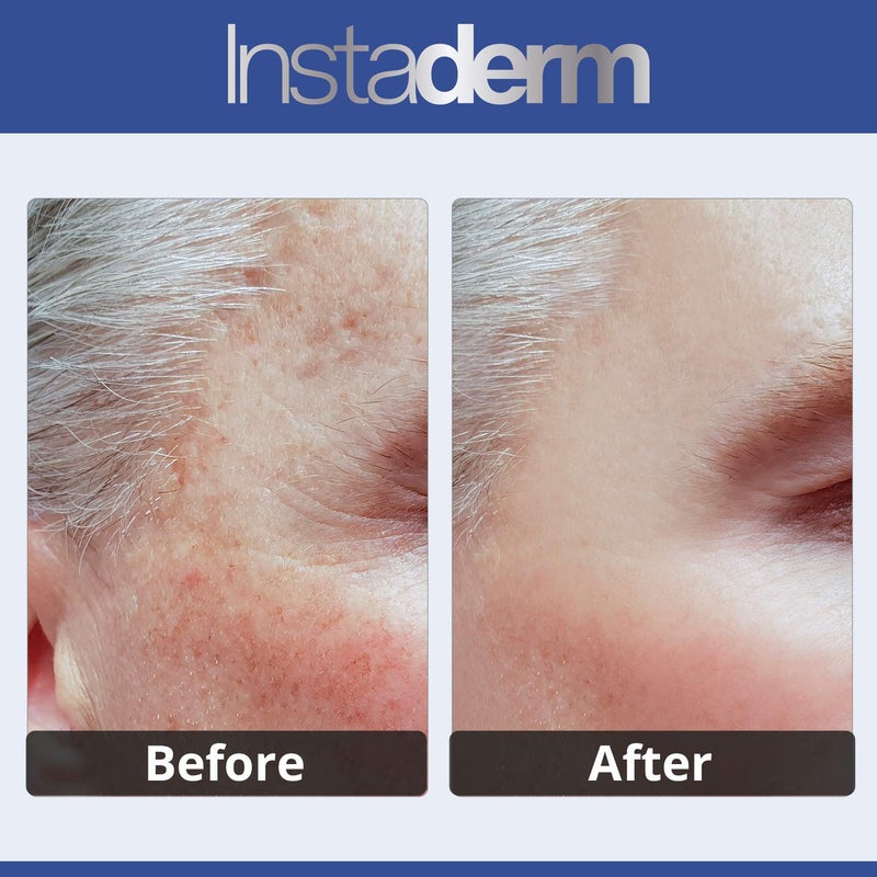 Instaderm كريم تصحيح البقع الداكنة المضاد للشيخوخة من إنستاديرم - يخفف بشكل طبيعي البقع الداكنة، بقع الشمس، بقع العمر، ندبات حب الشباب، البقع البنية والنمش لبشرة أكثر إشراقًا وترطيبًا. - Image 3