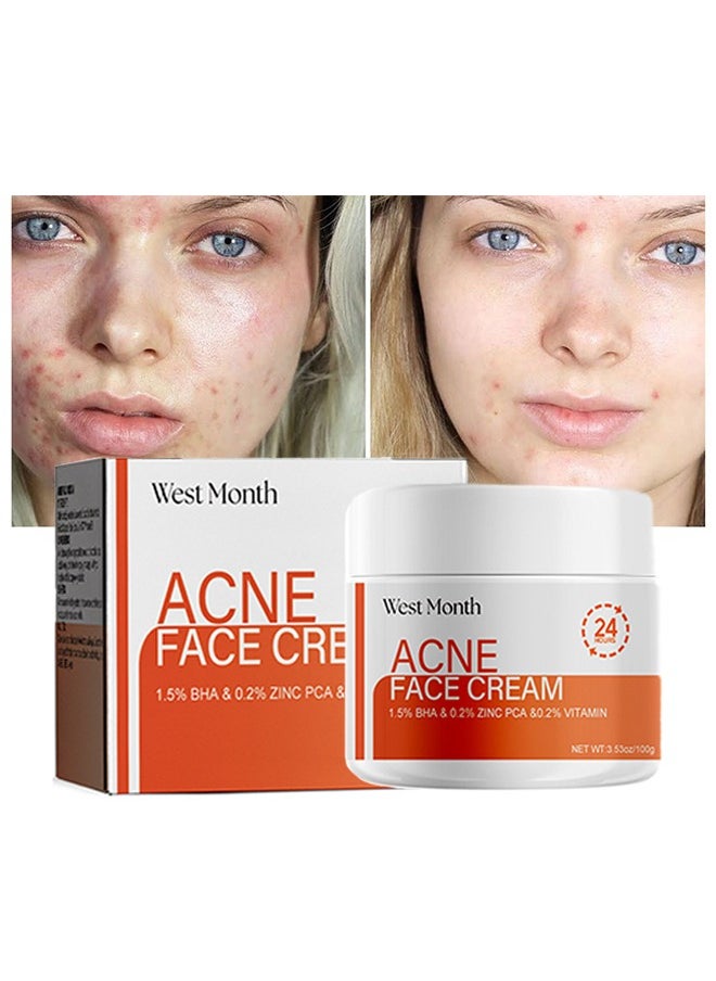 West&Month Acne Face Cream, Acne Spot Treatment for Face & Acne Dots, Natural Cystic Acne Treatment, For All Skin Types, Premium Acne Scar Cream & Pimple Remover 100g  - Image 2