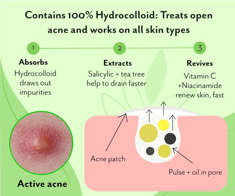 Urban yog Acne Pimple Patch 72 Invisible Facial Stickers cover with 100 Hydrocolloid Acne Pimple Patch Pack of 2 - Image 3