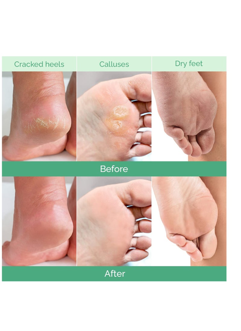 Plantifique - PLANTIFIQUE Foot Peeling Mask (2 Pairs) - Peeling Foot Mask Dermatologically Tested Repairs Heels & Removes Dry Dead Skin for Baby Soft Feet - Exfoliating Foot Peel Mask for Dry Cracked Feet (Peach) - Image 1