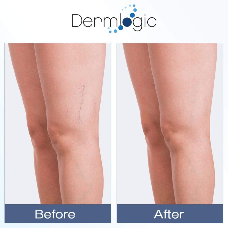 Dermlogic كريم فيتامين ك - تركيبة مرطبة لعلاج الكدمات. مصحح للبقع الداكنة للكدمات، الأوردة العنكبوتية والأوعية الدموية المكسورة. يقلل من الهالات السوداء تحت العين، الخطوط الدقيقة، الانتفاخ، والتجاعيد مع الأرنكا. - Image 3