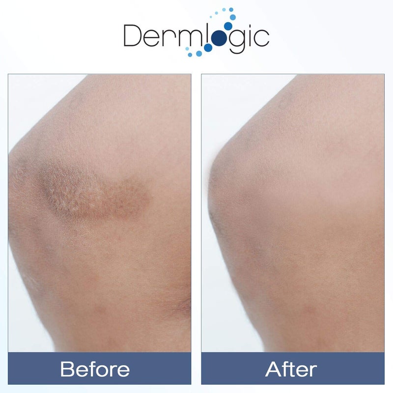 Dermlogic كريم فيتامين ك - تركيبة مرطبة لعلاج الكدمات. مصحح للبقع الداكنة للكدمات، الأوردة العنكبوتية والأوعية الدموية المكسورة. يقلل من الهالات السوداء تحت العين، الخطوط الدقيقة، الانتفاخ، والتجاعيد مع الأرنكا. - Image 4