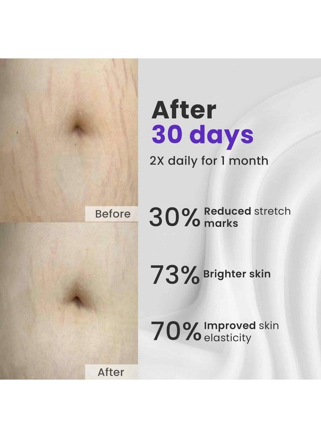 Saffr'n Anti Stretch Marks Cream co-developed by Gynaecologist suitable for all Stretch Marks | With Shea Butter, Hyaluronic Acid, and Collagen | Scar Removal | Uneven Skin Tone | Vitamin C and Retinol | 50ml - Image 3