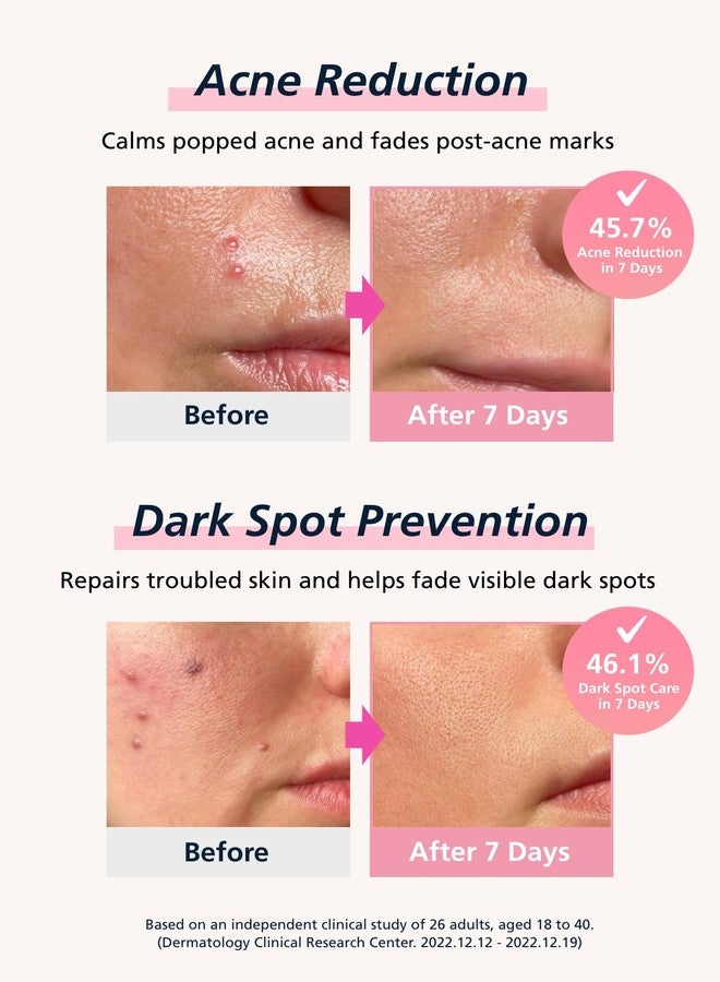 DWEasyDerm Easyderm Real Calming Patch Microdart Pimple Patches, Clear Nano Micropoint | Niacinamide, Hyaluronic Acid, EGF Acne Dark Spot Care, K-beauty | 12 Counts Summer & Travel Essentials - Image 4