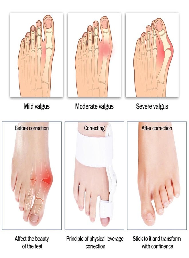KRUPAVI Bunion Corrector for Women, Bunion Thumb Corrector, Right Foot Thumb Bunion Splint Adjustable Toe Separator for Women and Men Correction for Day Night Support (Multi Color) - Image 4
