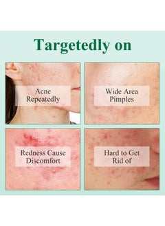 Breylee Tea Tree Oil Acne Serum, BREYLEE 2.0 Treatment Acne Prone Sensitive Skin Care Face Serum to Cystic Acne Scars, Redness Relief, Pimples Dark Spots Remove, Niacinamide Facial Moisturizer,17ml/0.6fl oz  - Image 4