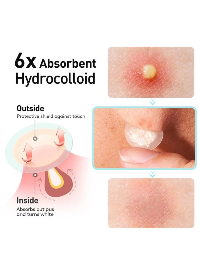 TKTK Pimple Patches, 12mm Invisible Acne Patches for Face with Salicylic Acid, 0.01cm Extra Thin Outer Edge, Hydrocolloid Zit Patch for Pustule, Whitehead, Cystic Acne Spot, 96 Count - Image 3
