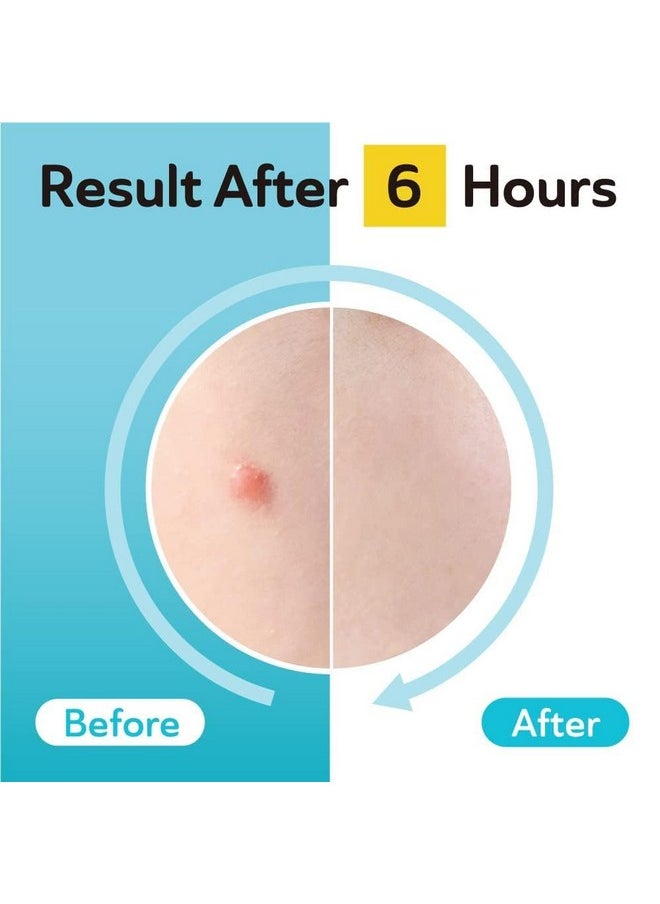Acne & Post Acne Patches - Hydrocolloid Pimple Care With Txa & Cica For Active Acne & Post-Inflammatory Dark Spots - Day And Night Use - Upgraded (Post Acne - 96 Count - 1 Size)