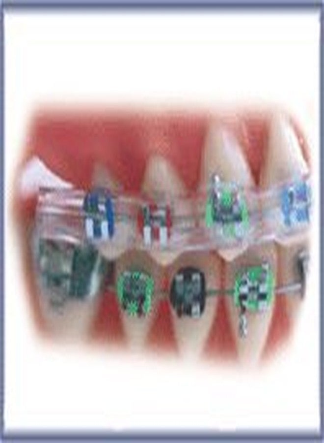 Morgan Bumper Braces Cover Lip Protector for Orthodontic Patients - Clear - Qty 2 - Image 2