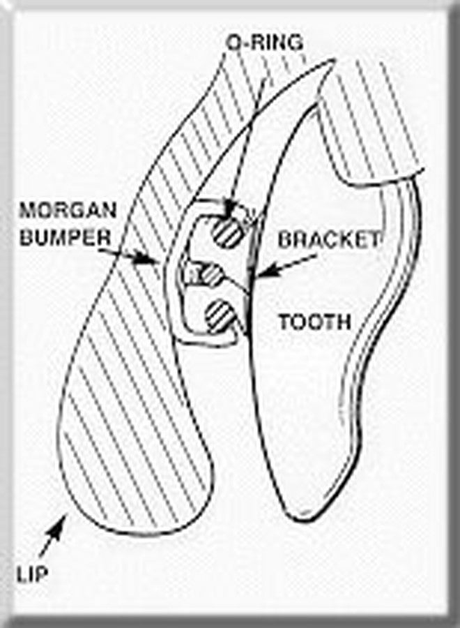 Morgan Bumper Braces Cover Lip Protector for Orthodontic Patients - Clear - Qty 2 - Image 3