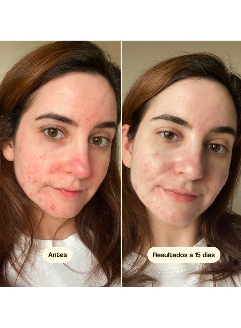 Freshly Azelaic Radiance Face Treatment for Acne-Prone and Reactive Skin 15ml - Image 3