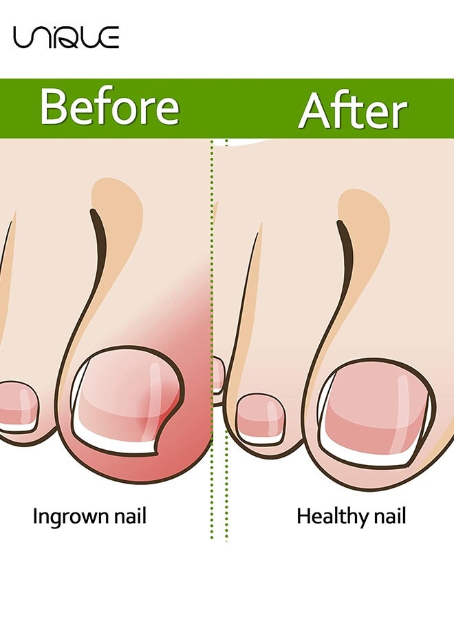 Unique 60 Pieces IIngrown Toenail Corrector Set - Strips Ingrown Toe Nail Correction Brace Correction Clip Toe Nail Straightening Recover Patch Curved Toenail Corrector for Women Men Foot Care - Clear - Image 4
