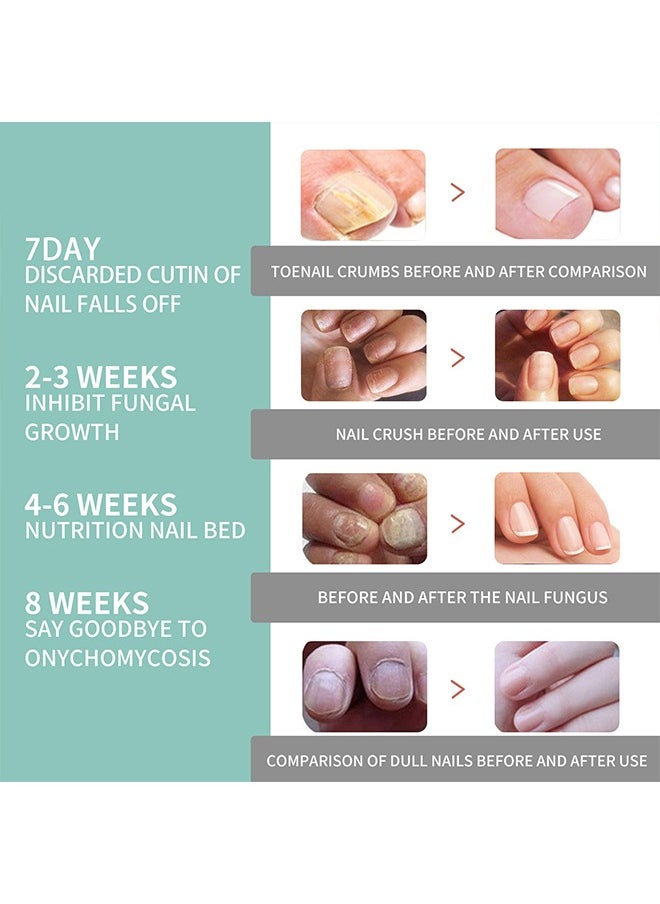 SOUTH MOON - Nail Care Pen - Suitable for Repairing Onychomycosis and Dead Skin and Moisturizing Nails, Prevent Paronychia Treat Nails Healthy Nail Pen Oil - Image 1