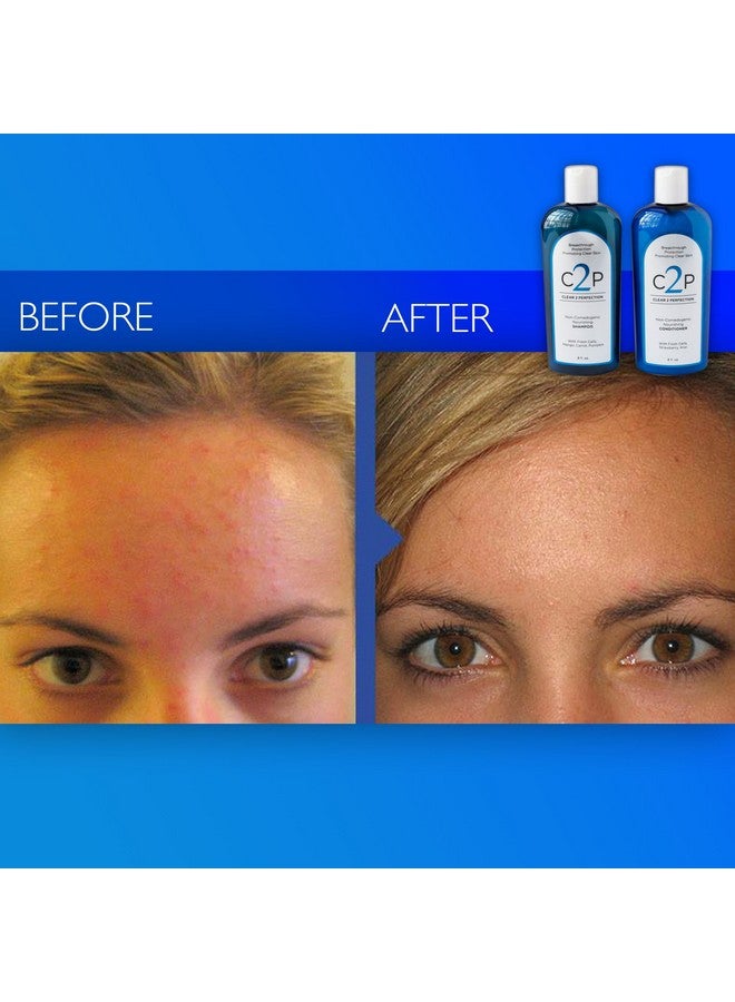 C2P Clear 2 Perfection Noncomedogenic Shampoo & Conditioner Set For Blemish Free Skin With Antioxidants And Fresh Cells. Acne Shampoo And Conditioner Made In The Usa. - Image 5
