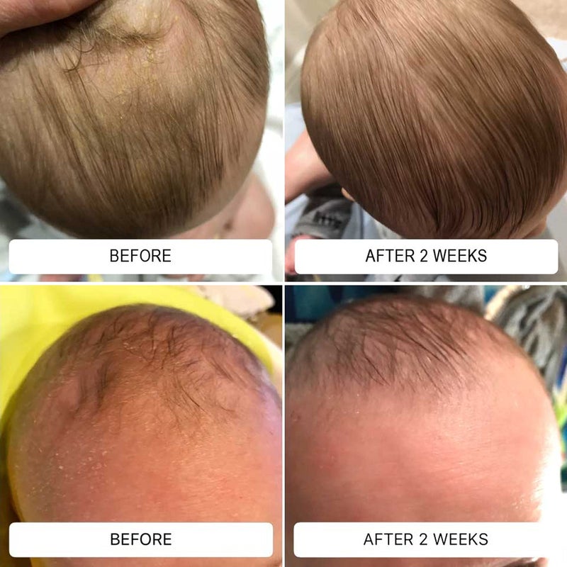 Happy Cappy Daily Medicated Shampoo and Body Wash Bundle - Baby Dandruff Shampoo, Helps Cradle Cap and Seborrheic Dermatitis, Reduces Redness, Dermatologist Tested, Fragrance-Free - 4 Pieces - Image 4