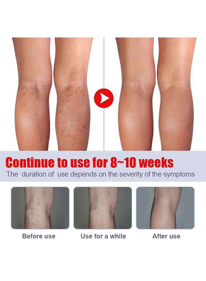 كاني إتش بي الوريدات الدوارية إزالة كريم 20g, كريم الرعاية الوريدية الدورة الدموية الساق, التهاب الأوعية الدموية التهاب الجلد مرهم الرعاية القدم, علاج تخفيف الألم تثبيت الوريد كريم لعلاج الوريدات الدوارية - Image 4