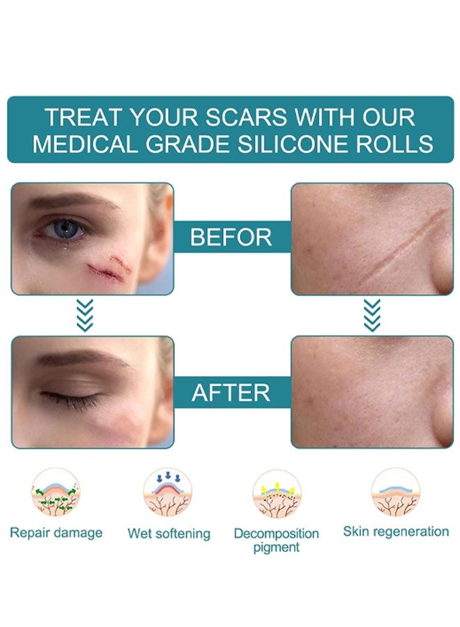 Medical Grade Silicone Scar Sheets, Silicone  Scar Tape  Scar Removal Strips for Acne Scars C-Section & Keloid Surgery Scars Sheets Treatment Sheets - 6-8 Month Supply - Image 3