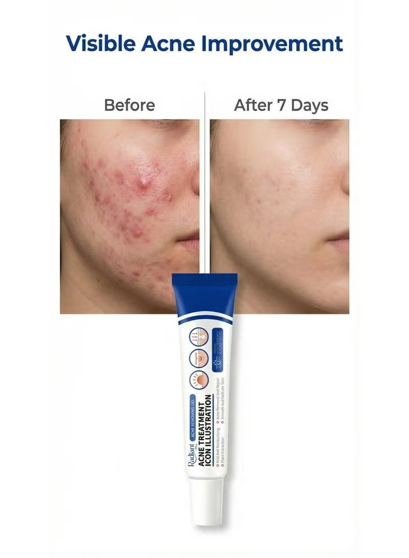 Radiant Anti Acne Treatment Cream，Anti Acne Gel Moisturizing For Oily And Acne Prone Skin - Image 1