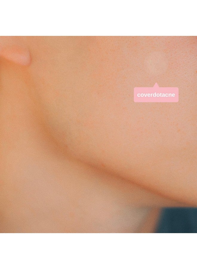 SMARTMED Ollie Belle Cover Dot Acne Care Skin Blemish Treatment with Hydrocolloid | Clear, Waterproof Patch (240 dots) - Image 4