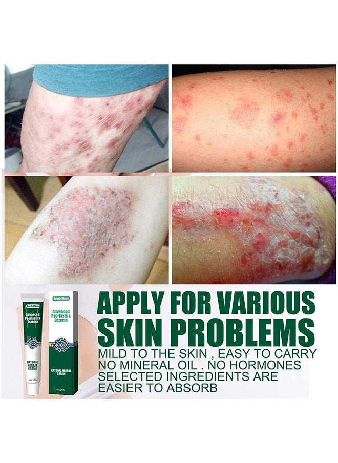 SOUTH MOON - Advanced Psoriasis&Eczema Natural Herbal Cream，Organic Eczema Herbal Healing Cream, Chinese Herbal Eczema, Natural Herbal Cream, Psoriasis Ointment Cream, Moisturising Cream, Face Cream, Body Cream for Dry Skin, Itch Skin, Itch Relief Cream 20G - Image 1