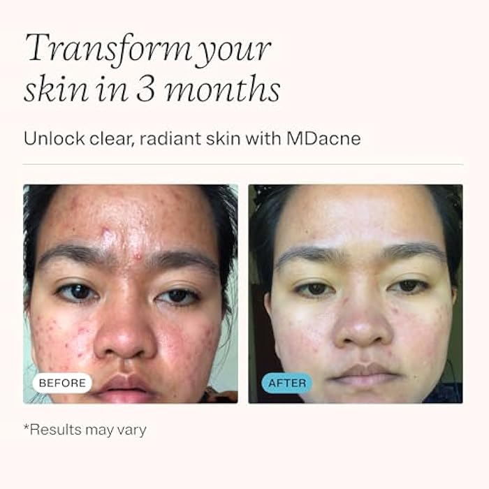 MDacne مجموعة علاج حب الشباب للوجه من MDacne 3 خطوات، كريم بنزويل بيروكسايد 2.5%، منظف حمض الساليسيليك، مرطب نياسيناميد – عناية بالبشرة نباتية طبية لحب الشباب للبالغين والمراهقين، مجموعة 30 يوم - Image 3