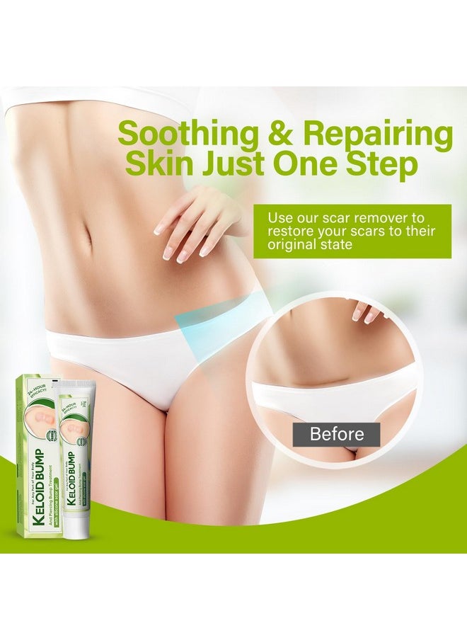 Hajoyful Keloid Bump Removal, Scar Treatment Cream, Silicone Acne Scar Gel, Gentle Effective Aftercare Solution for Injury & Surgery, Skin Repair for Face & Body, 20g  - Image 3