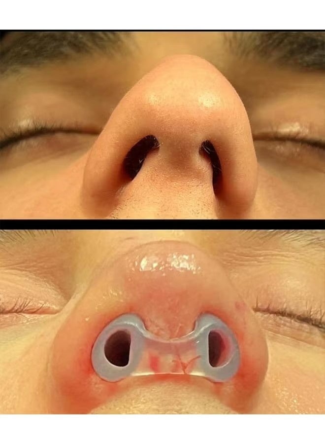 Face healthly Silicone Nostril Retainer and Micropore Tan Surgical Tape 1.25cm Wide, Nose Pad for Surgery, Nose Retainer Rhinoplasty, Retainer for Work Surgery,%100 Silicone Nose Stud Nose Shaper (No. 6) - Image 5
