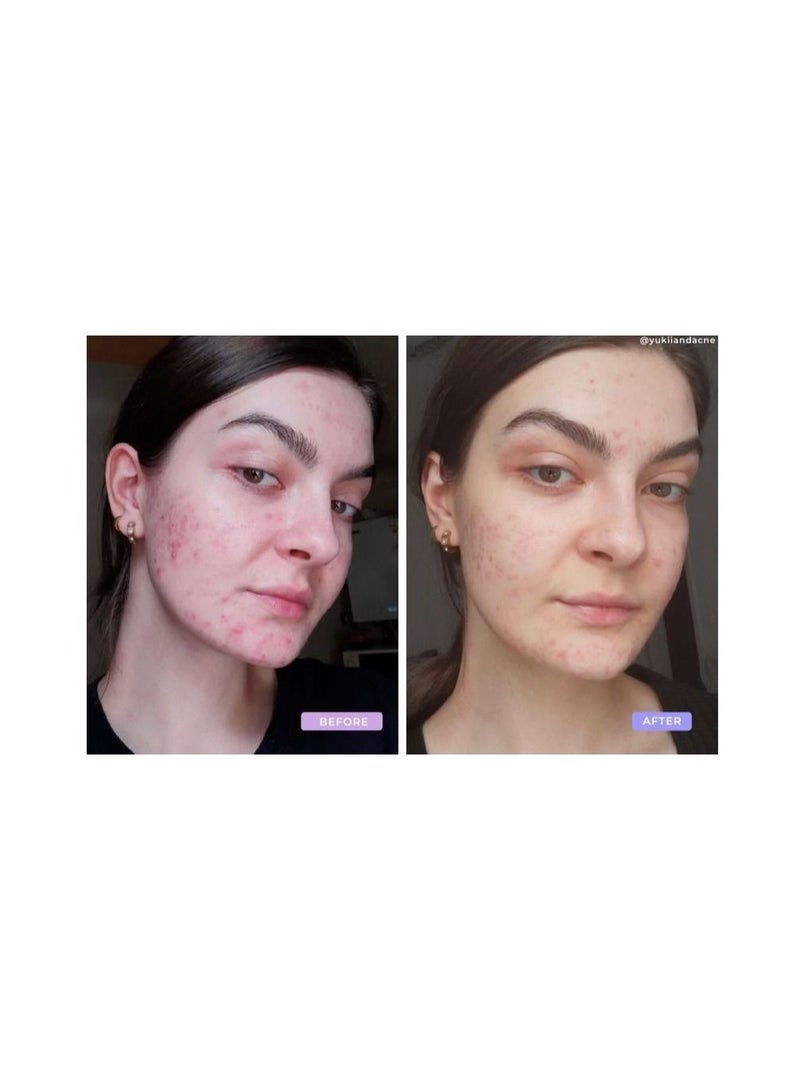 DemarkQ DemarkQ POP Red Light Therapy Device Anti Acne Skincare Reduce Dark Spots & Scars Calm Inflammation and Sensitive Skin Remove Blemishes For Skin Rashes and Oily Skin Handheld Device - FDA Cleared. - Image 2