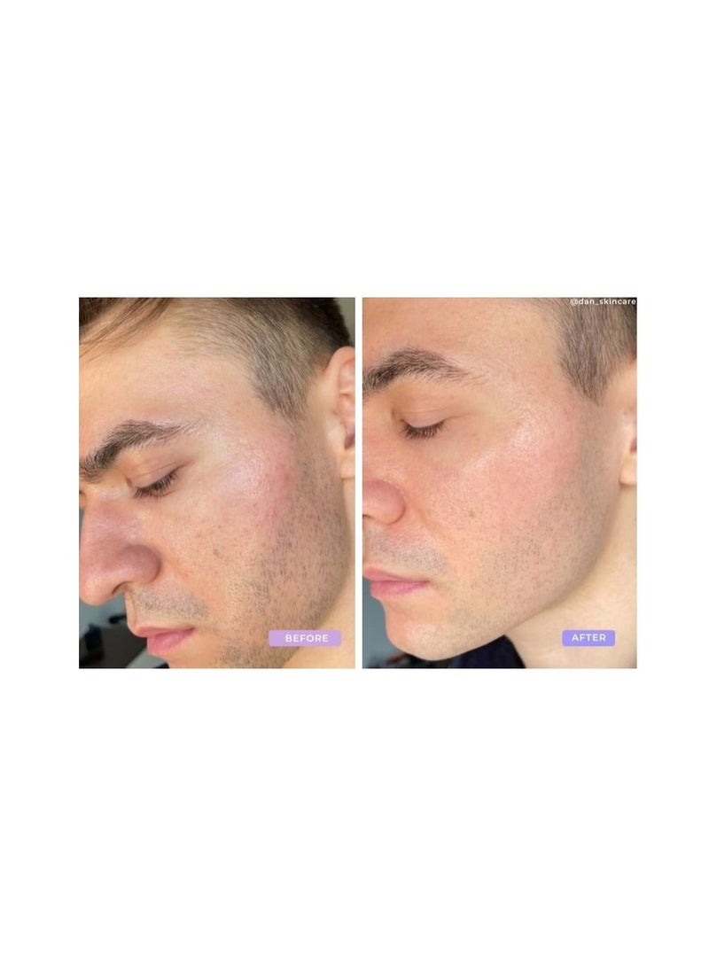 DemarkQ DemarkQ POP Red Light Therapy Device Anti Acne Skincare Reduce Dark Spots & Scars Calm Inflammation and Sensitive Skin Remove Blemishes For Skin Rashes and Oily Skin Handheld Device - FDA Cleared. - Image 3