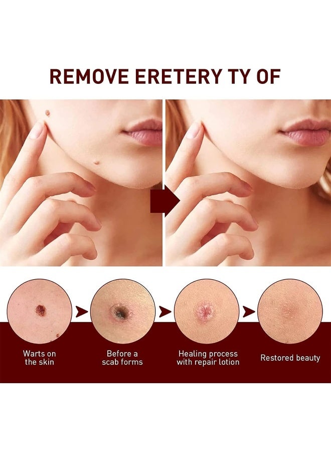 2023 Best Wipeoff Tags & Moles Remover, Mole Remover Fast Easy Effective in 5 Days, Easy to Remove, Restore Skin Health and Beauty, for All Body Parts (1Pcs) - Image 4