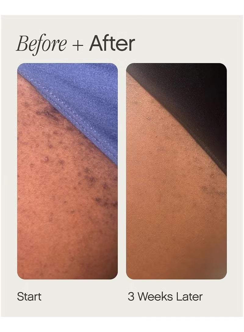 TOPICALS RAZOR BUMPS & IRRITATION? This lightweight, roll-on ingrown hair treatment is the sure bet to soothe shaving irritation & prevent bumps from ingrown hairs. Hygienic, easy-to use, mess-free package makes treating ingrown hair concerns a breeze. - Image 2