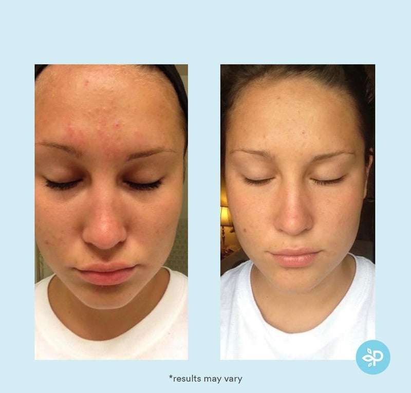 PERFECT IMAGE Glycolic Acid 30% Gel Peel - Enhanced with Retinol and Green Tea Extract (Professional Chemical Peel)- 1 fl oz 30mL - Image 5