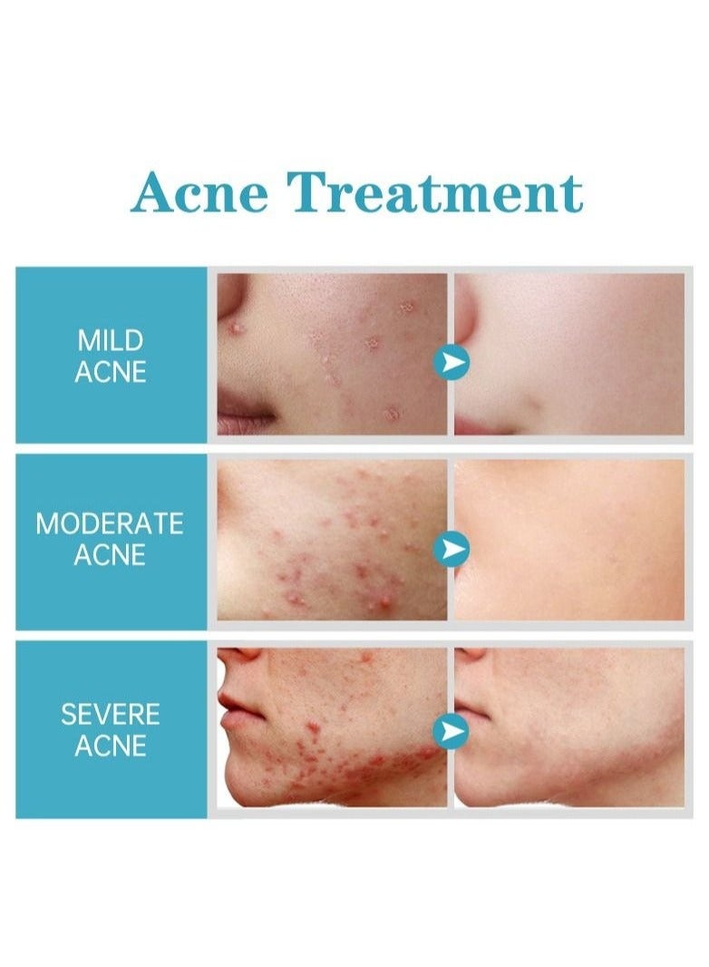 AuQuest Salicylic Acid Acne Face Cream Whitening Facial Treatment Hyaluronic Acid Black Dots Remove Skin Care Beauty Health - Image 5