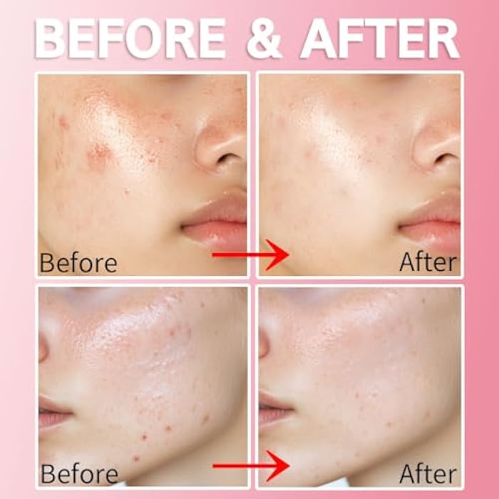 Purederm Blemish Spot Treatment Gel with Salicylic Acid 2%, Soothing Acne Care for Irritated Skin, Day & Night Use, 20ml - Image 4