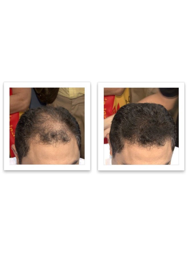 Caboki Hair Building Fiber 25g - Dark Brown - 3 X Value Triple Pack - Image 4