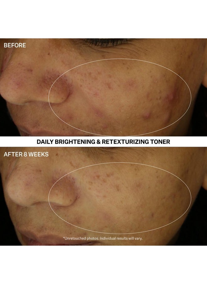 Strivectin Multiaction Clear Daily Brightening & Retexturizing Toner For Acne Blemished Skin And Break Outs 4 Fl Oz  - Image 3